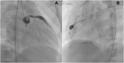 Heart Transplantation in a <mark class="highlighted">Toddler</mark> with Cardiac Kawasaki Disease